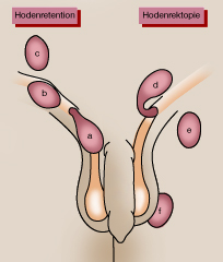 Leistenhodenschema_s2 Leistenhodenschema_s2