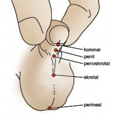 hypospadie_sa hypospadie_sa