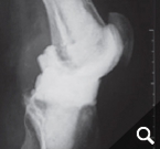 Implantierte Spacer nach Prothesenentfernung Implantierte Spacer nach Prothesenentfernung